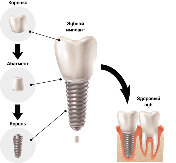 implant struktura1