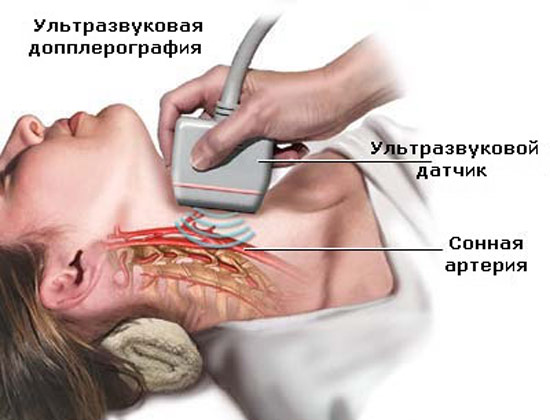 Патологическая деформация (извитость) брахиоцефальных артерий